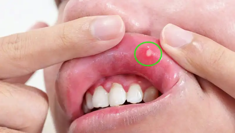 Vücudunuzu Tehlikeye Atan 5 Belirgin B Vitamini Eksikliği Belirtisi