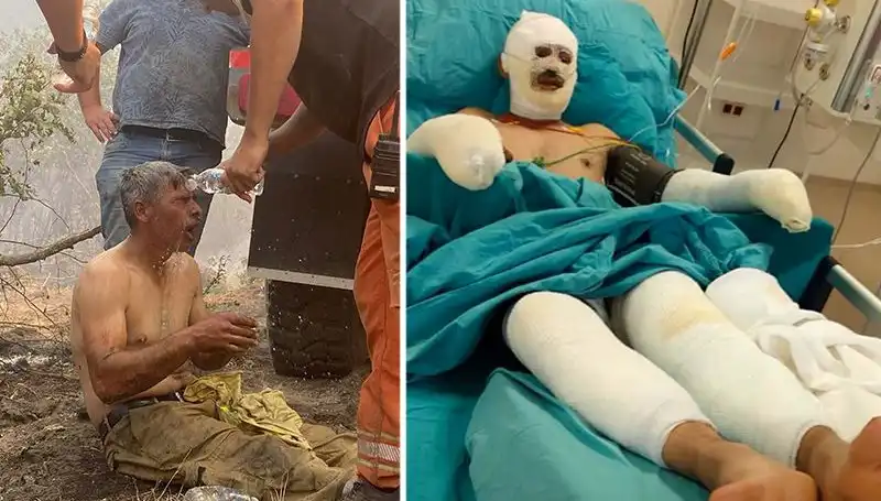 Yanıyorum Diye Feryat Eden Orman İşçisinin Tedavisinde Son Durum Nedir?